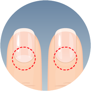 Fingernails showing possible clubbing symptoms