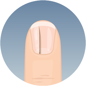 Fingernail with vertical ridge abnormality